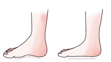 扁平足は『股関節』から治せ！